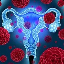Dostarlimab/Chemotherapy Under EMA Review for Primary Advanced/Recurrent Endometrial Cancer