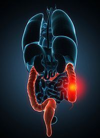 colorectal cancer