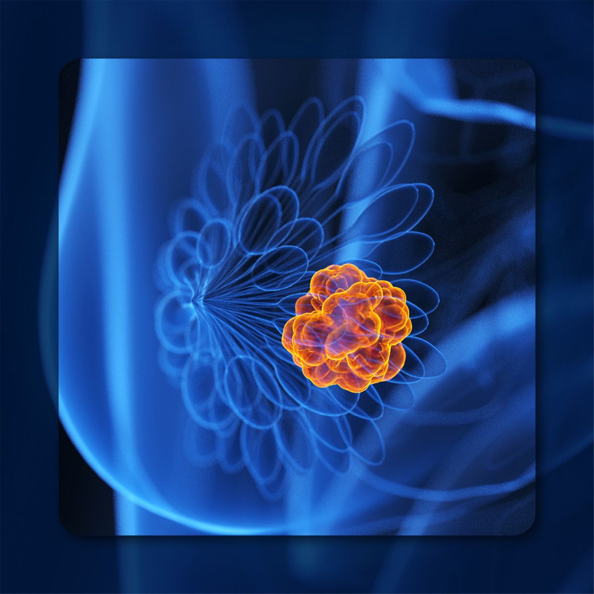 Vepdegestrant in Breast Cancer | Image Credit: © Sebastian Kaulitzki – stock.adobe.com