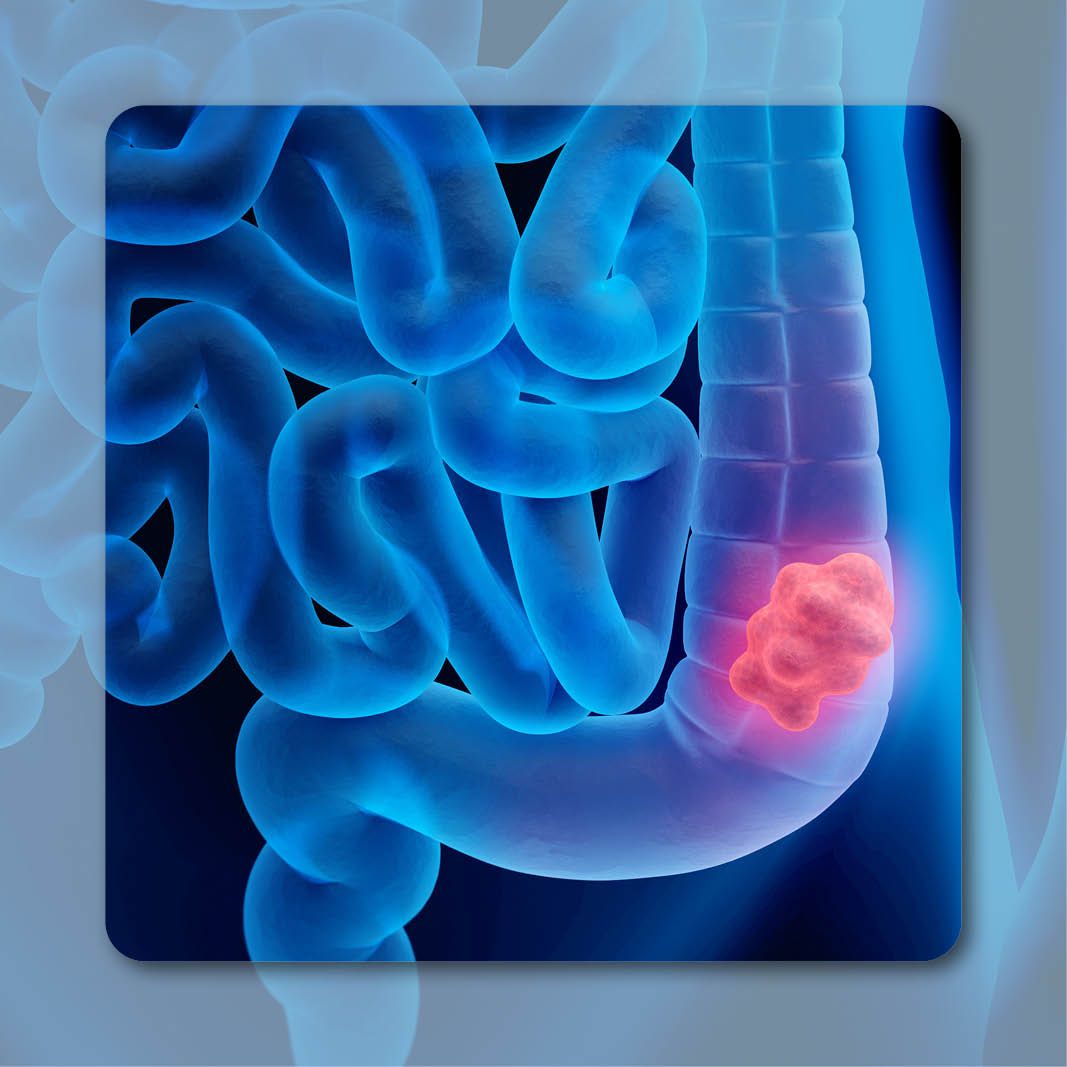 Colorectal Cancer