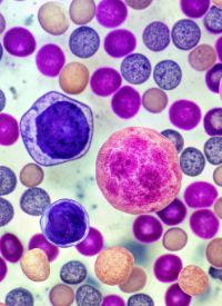 Anito-Cel in Myeloma | Image  Credit: © Curie - stock.adobe.com