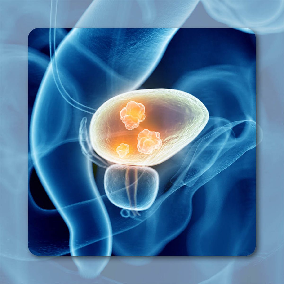 Muscle-Invasive Bladder Cancer | Image  Credit: © Sebastian Kaulitzki – stock.adobe.com