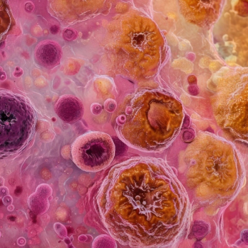 VP-315 in Basal Cell Carcinoma | Image Credit: ©2rogan - stock.adobe.com