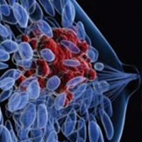 Breast cancer