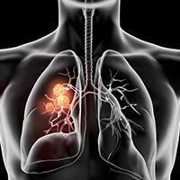 Cemiplimab/Chemo Represents New Frontline Option for Advanced NSCLC Without Actionable Mutations