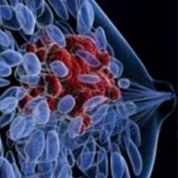 breast cancer