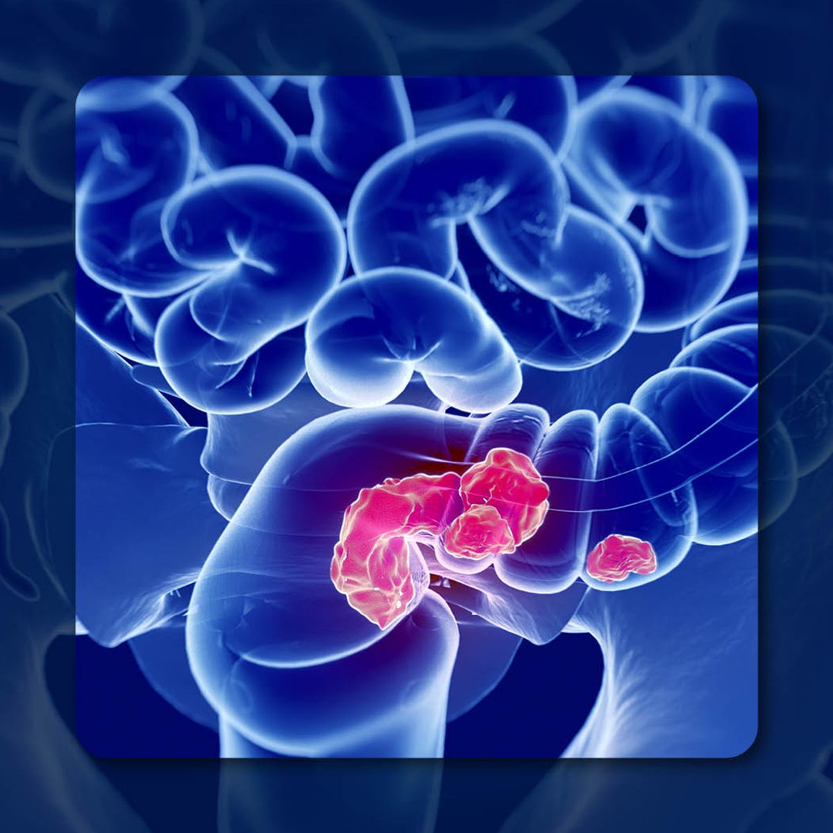 The Microbiome and Colon Cancer | Image Credit: © Anatomy Insider - stock.adobe.com