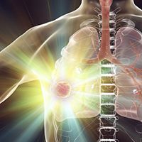 Non–Small Cell Lung Cancer