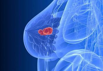 Oral SERDs in HR+/HER2– Metastatic Breast Cancer
