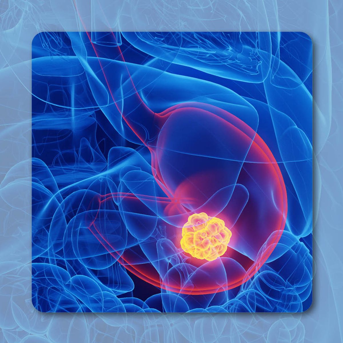 Zolbetuximab Plus Chemotherapy Offers Survival Benefits in