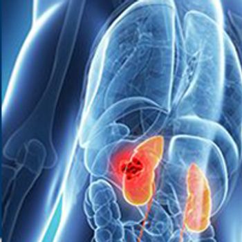 Renal Cell Carcinoma