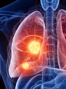 Summarizing Clinical Advances in the Management of MET Exon 14 Skipping Mutated–NSCLC