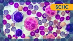 SC Daratumumab Prolongs PFS in High-Risk Smoldering Myeloma