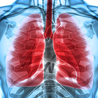 Lung cancer