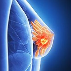 Risk of Lymphedema Is Comparable With Hypofractionated Radiation in Early Breast Cancer