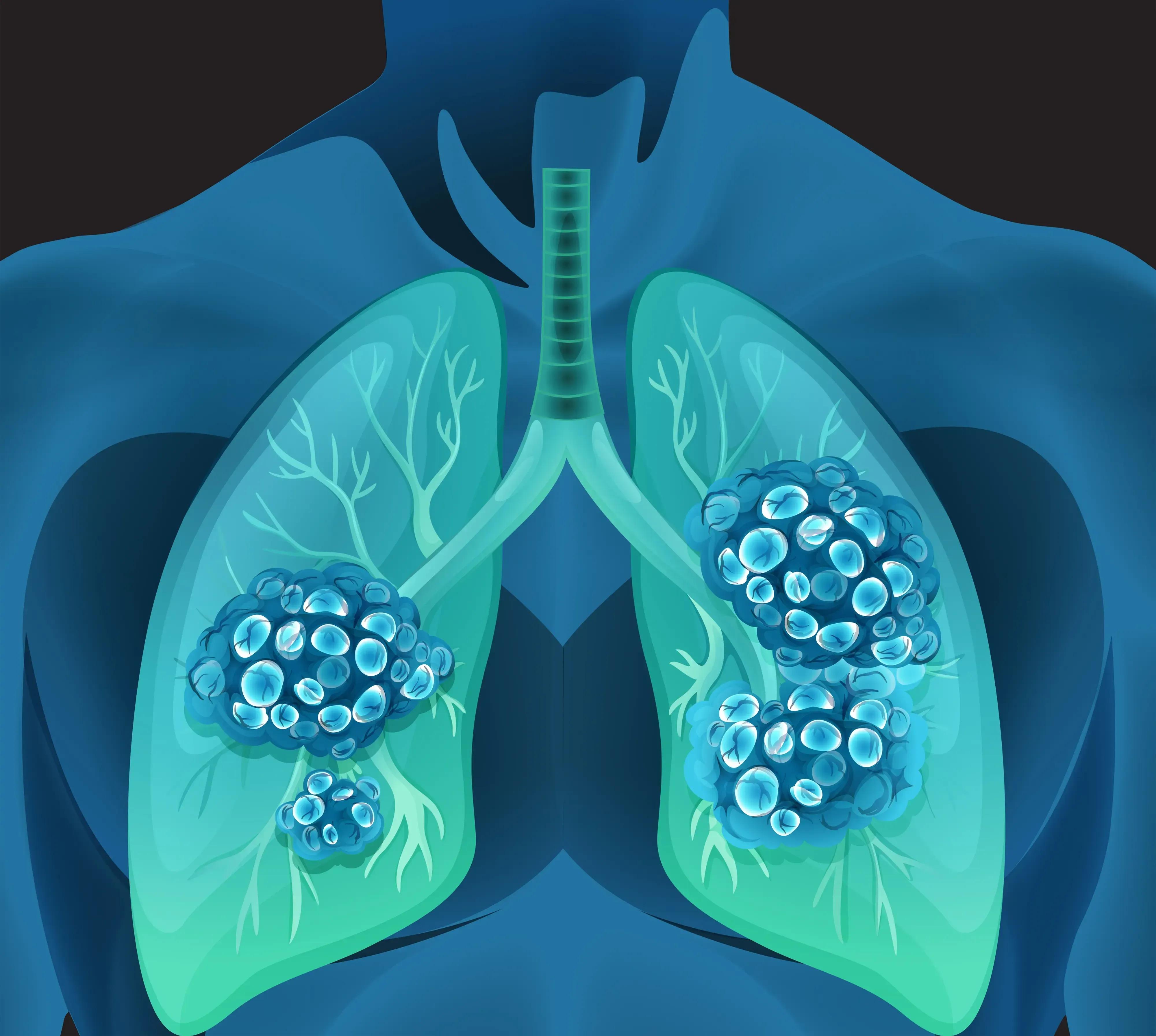 Sunvozertinib in EGFR exon 20–positive NSCLC Sunvozertinib in EGFR exon 20–positive   NSCLC | Image Credit: © blueringmedia - stock.adobe.com