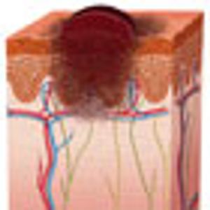 Melanoma Breakthroughs Among Top 2011 Cancer Advances