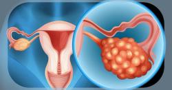 Relacorilant NDA Is Under FDA Review for Platinum-Resistant Ovarian Cancer