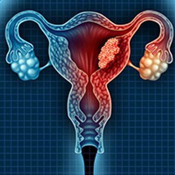 Ovarian Cancer