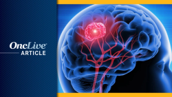 IGV-001 Prolongs OS vs Placebo in Newly Diagnosed Glioblastoma