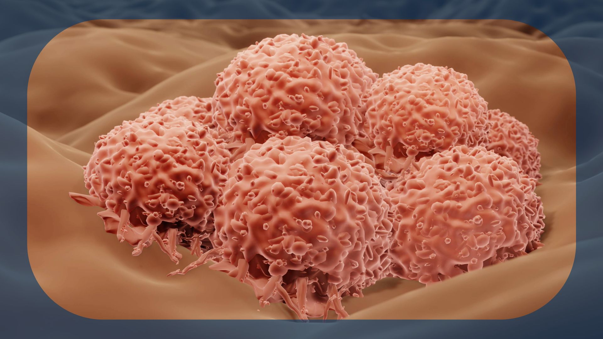 Resectable Melanoma | Image credit:  © Artur - stock.adobe.com