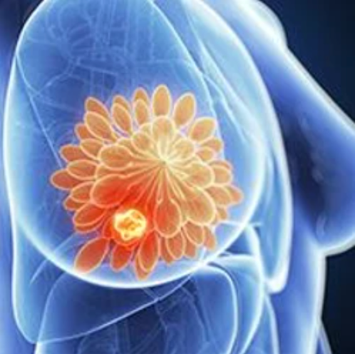 Frontline Ribociclib Plus Endocrine Therapy Provides PFS Benefit in Pre/Perimenopausal HR+/HER2- Advanced Breast Cancer