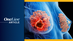 UCSF Study Finds a Better Way to Screen for Breast Cancer