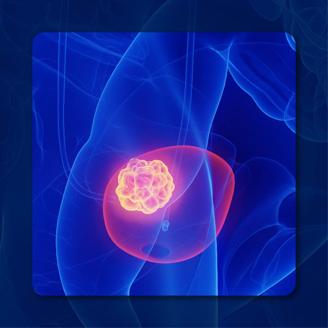 Urothelial Cancer | stock.adobe.com