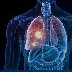 Scientific Interchange & Workshop | <b>Expanding Horizons: Antibody-Drug Conjugates in Non–Small Cell Lung Cancer</b>