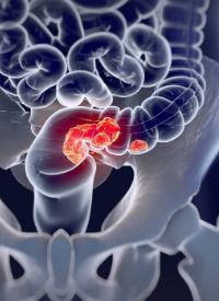 Colorectal Cancer | Image credit:   © Anatomy Insider - stock.adobe.com