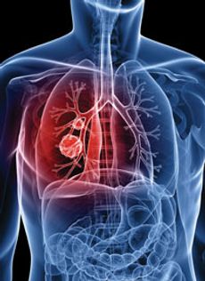 On the Horizon in NSCLC: Antibody Drug Conjugates