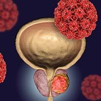 Darolutamide was linked with a reduction in locally invasive procedures, delayed time to deterioration in health-related quality of life related to urinary and bowel symptoms in patients with nonmetastatic castration-resistant prostate cancer.