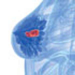 Development of PI3K Inhibitors in Breast Cancer