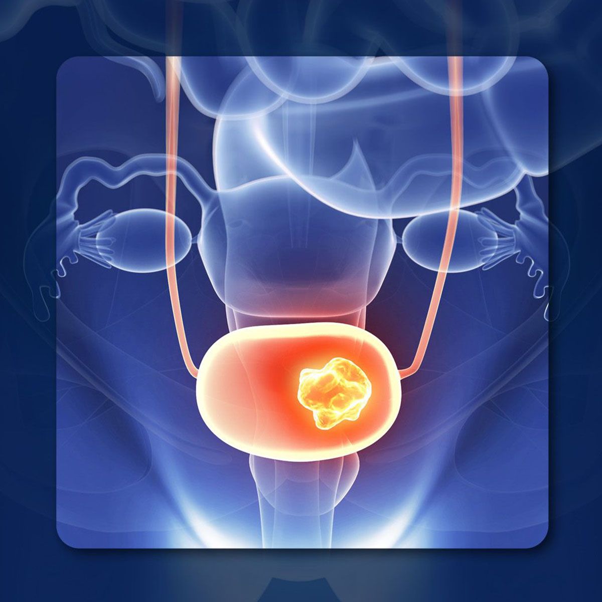 Perioperative Durvalumab for Muscle-Invasive Bladder Cancer | Image Credit: © Sebastian Kaulitzki – stock.adobe.com