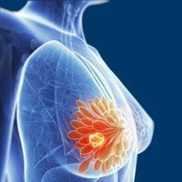 Breast Cancer