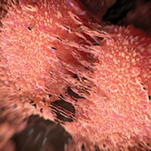 Feasibility Results Support Launching Full Phase III PART Trial in Prostate Cancer