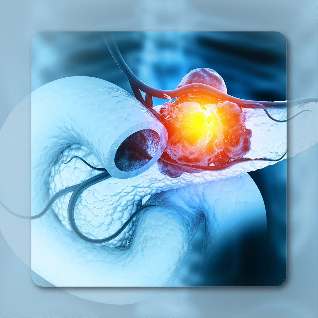 Pancreatic Cancer | Image Credit: © Crystal light - stock.adobe.com