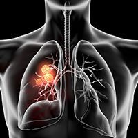 Scientific Interchange & Workshop | <b>Where Do ADCs Fit Into the Treatment Paradigm for Patients With NSCLC?</b>