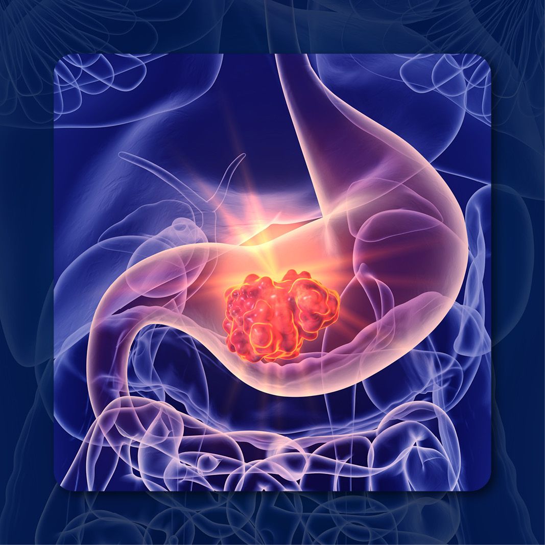 Gastrointestinal Cancer | Image Credit: © Crystal light – stock.adobe.com