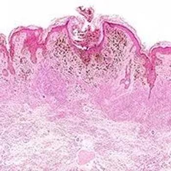 Cutaneous Squamous Cell Carcinoma