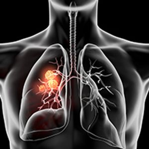 Alectinib Fails to Improve OS in ALK-Positive NSCLC
