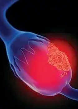 Ovarian cancer