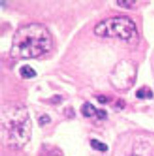 Wistar-Penn Collaboration Identifies HSP70 as Promising New Target for Melanoma Therapy