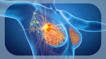 Bria-IMT in Metastatic Breast Cancer | Image Credit: © Axel Kock - stock.adobe.com