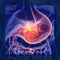 Cabozantinib Bests Placebo in Extrapancreatic NETs With Primary Tumor Arising in the Gl Tract