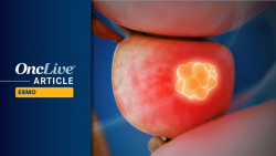 Alternative Docetaxel Regimen Plus Darolutamide/ADT Lowers Toxicity in mHSPC