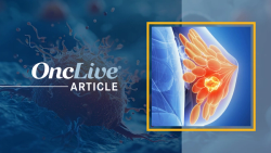OncLive Polls Highlight Top Votes on Anticipated Breast Cancer Abstracts at ESMO 2025