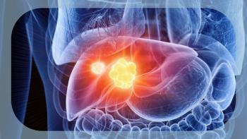 Hepatocellular Carcinoma | Image Credit: © Sebastian Kaulitzki - stock.adobe.com