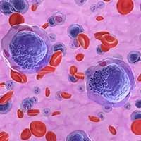 MRD Positivity in NPM1-Mutated AML | Image Credit: © LASZLO - stock.adobe.com