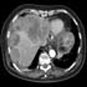 The Use of Tyrosine Kinase Inhibitors for Gastrointestinal Stromal Tumors (GIST)